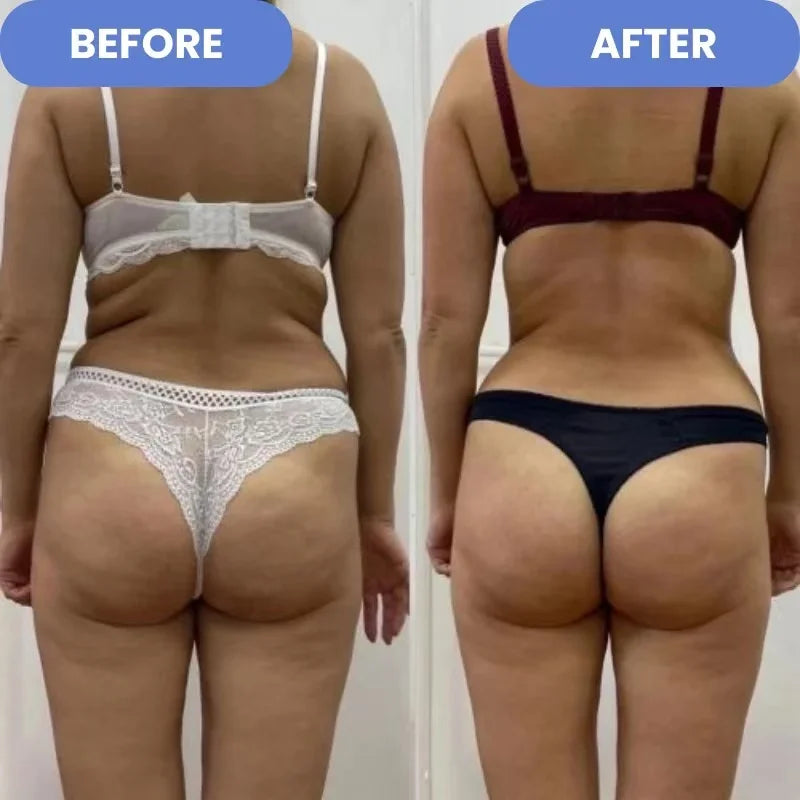 Masajeador Anti Celulitis