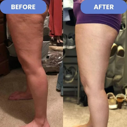 Masajeador Anti Celulitis